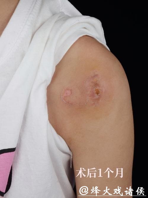 有没有人这个位置长瘢痕疙瘩？