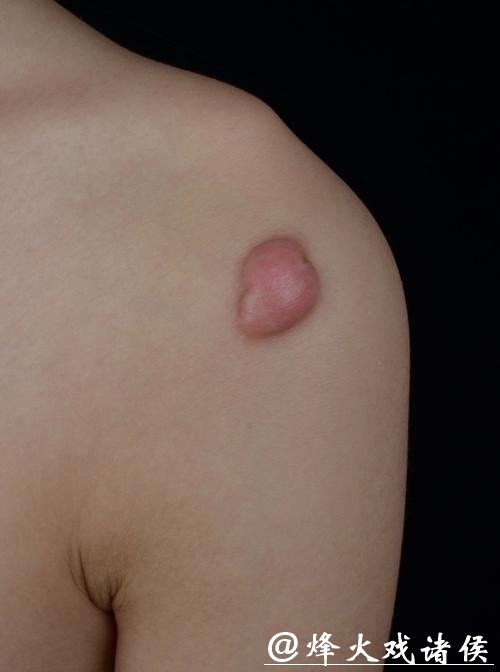 有没有人这个位置长瘢痕疙瘩？